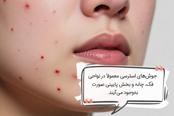 شکل جوش‌های استرسی